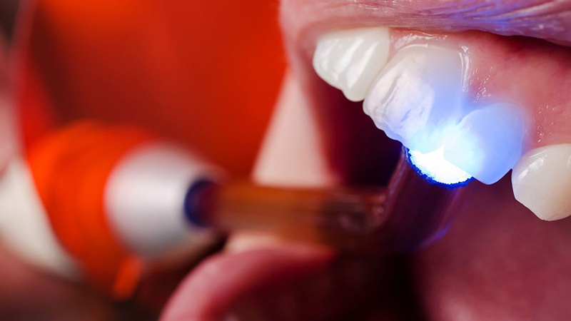 Бесплатная стоматология по полисам ОМС - Установка световых пломб
